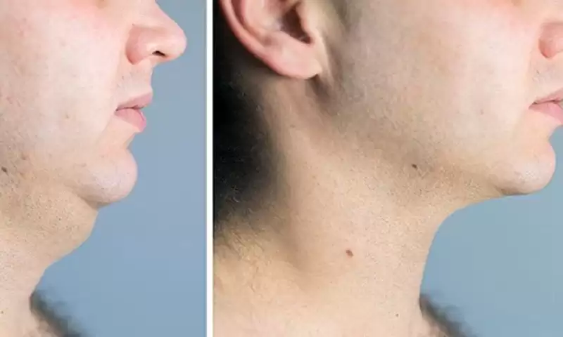 Delay The Signs Of Aging With Effective Neck Lift Surgery!