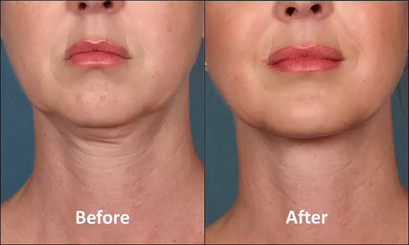 Double Chin Liposuction Treatment – All You Need To Know!