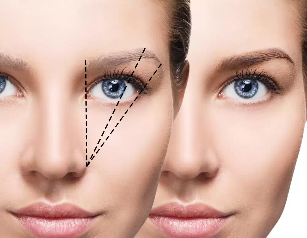 How to Find the Best Eyebrow Transplant Surgeon in London?