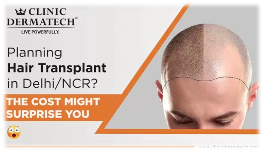 Myths And Facts About Hair Transplant In Delhi