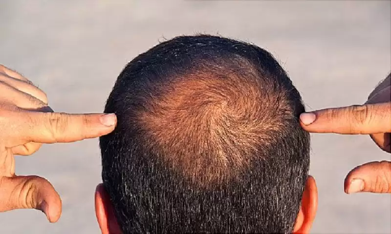 The Most Effective Hair Loss Treatment